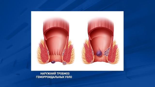 Тромбоз наружных геморроидальных узлов
