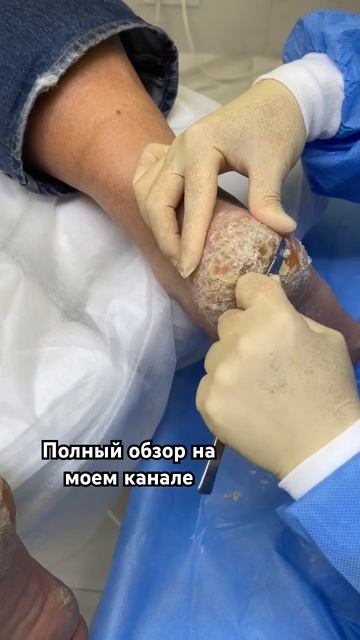 Полную версию shots смотрите на моем канале ПОДОЛОГИЯ ногтей и стоп #пятки #гиперкератоз
