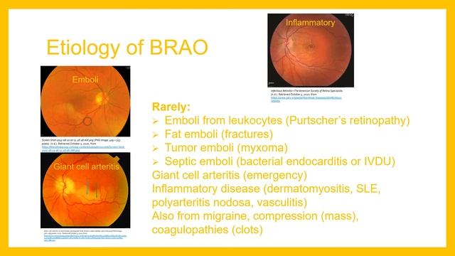 Branch Retinal Artery Occlusion and Carotid Artery Disease смотреть онлайн