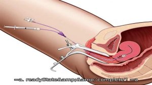 Как в домашних условиях провести искусственную инсеминацию и правильно подготовиться к процедуре?