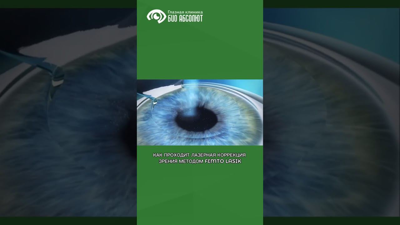 #лкз_биоабсолют #femtolasik #лазернаякоррекция #офтальмология #офтальмолог #БиоАбсолют смотреть онлайн