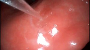 ХЕЛИКОБАКТЕРНЫЙ ГАСТРИТ & СИНДРОМ МЕЛЛОРИ-ВЕЙСА