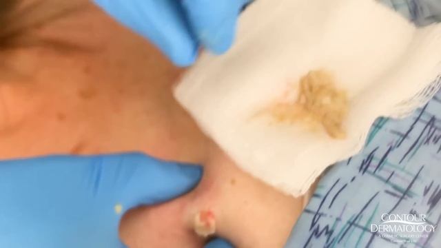 Cyst Salsa Verde Pop and Squeeze Extraction