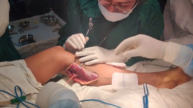 Medial Sural Artery Perforator Flap. смотреть онлайн