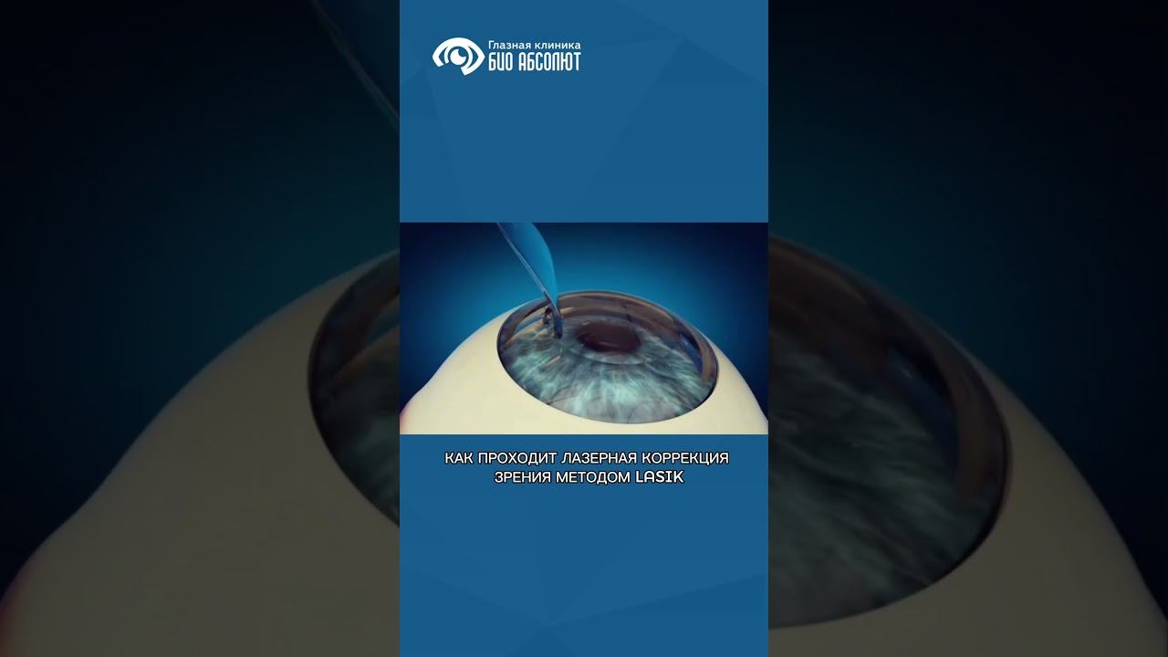 #лкз_биоабсолют #лазернаякоррекция #Lasik #офтальмолог #офтальмологическийцентр смотреть онлайн