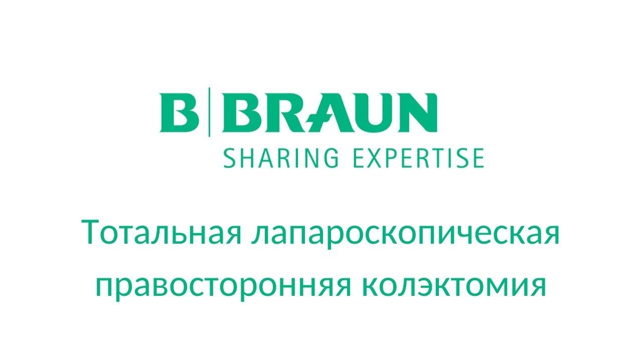 Caiman 5 мм: тотальная лапароскопическая правосторонняя колэктомия
