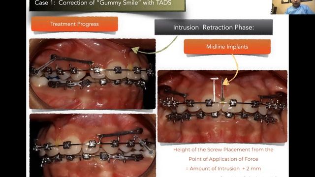 [LECTURE: 8] Gummy Smile Correction with Damon System and Mini-implants | Orthodontic Biomechanics смотреть онлайн