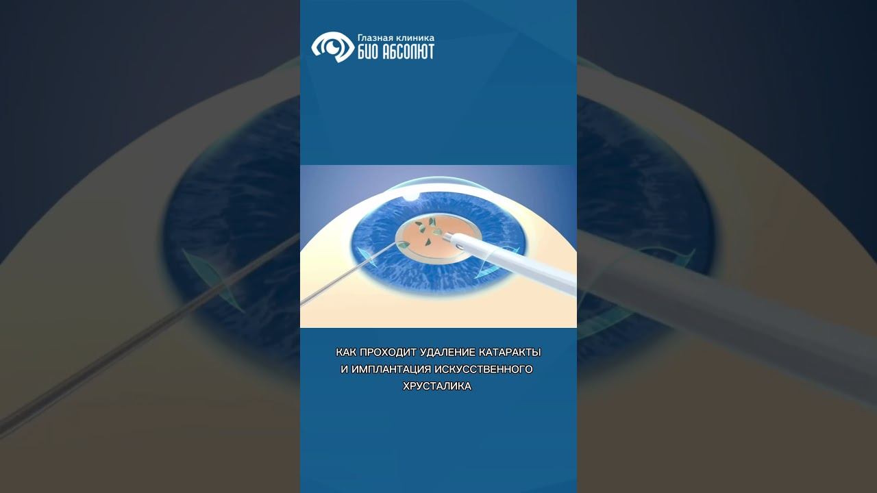 #здоровьеглаз #катаракта #глаукома #лечениекатаракты #иол #ковров #иваново #офтальмолог #глаза смотреть онлайн