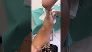 Закрытый перелом наружной лодыжки со смещением. 3 день после операции