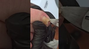 Педикюр. Очень скрученные ногти. Девушке больно ходить.