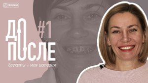 Брекеты ДО и ПОСЛЕ №1 // Ortodony