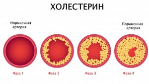 Завышенный холестерин, что делать?