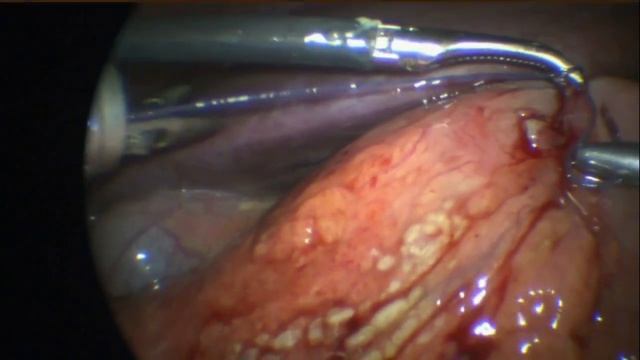 Лапароскопическое ушивание перфоративной язвы двенадцатиперстной кишки смотреть онлайн