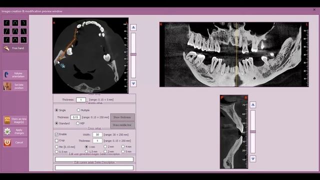 Insights Diagnostic - iRys Software Tutorial Video - Mandibular / Dentoalveolar Canal Tracing смотреть онлайн