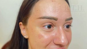 Пересадка бровей