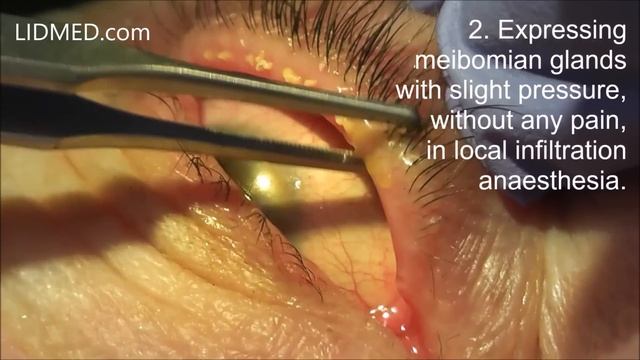 Occluded meibomian glands. Expressing under local anaesthesia. Dr. Aral - Cologne. смотреть онлайн