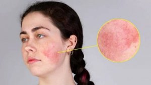 Причины розацеа у женщин