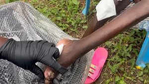 Andera jigger dug - she was so pregnant, malnourished and jiggered - ANOTHER FREE VIDEO