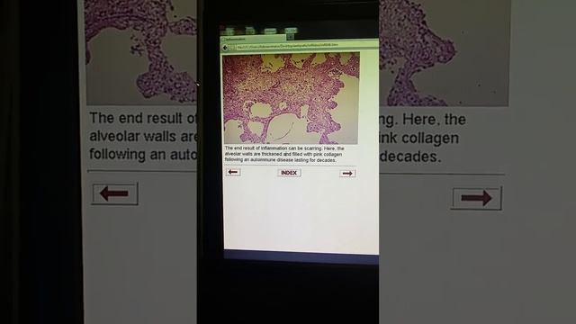 Pathology Lab #4: Chronic Inflammation