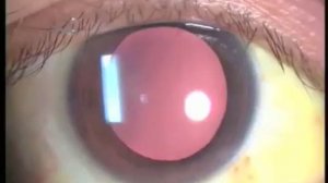 Как выполнять офтальмоскопическое исследование при попомщи прямого офтальмоскопа HEINE