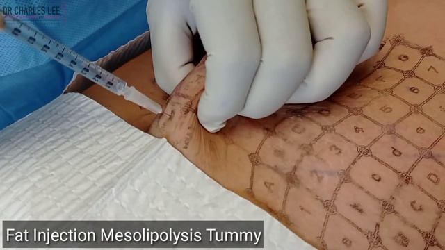 Non-Surgical Body Contouring With Fat Injection Mesolipolysis смотреть онлайн