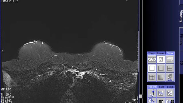 MRI-Breast manual - Siemens Aera 1.5T