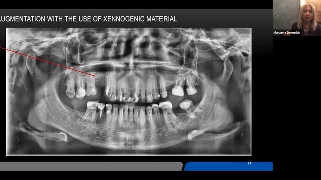 Extracted Teeth into Autologous Dentin Graft - A 4 Year Retrospective by Prof. Dr. Marzena Dominiak