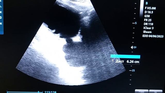 Siydik qopi (pufagi) divertikuli. Prostata bezi adenomasi 3-daraja. Siydik qopi devori o'smasi.