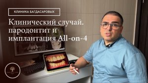 Пародонтит и имплантация All-on-4