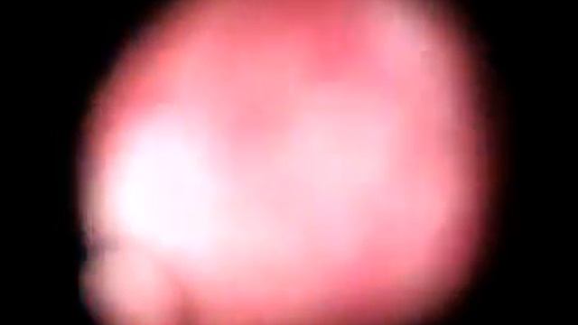 Full video,Film,Laparoscopy,Hysteroscopy,Gastroscopy,Endoscopy,IVF,USG,Colposcopy,ENT,Urologist