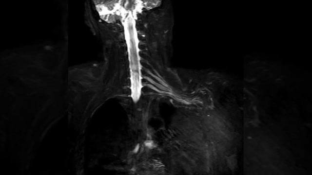 brachial plexus MRI with 3D CUBE STIR on GE HDXt