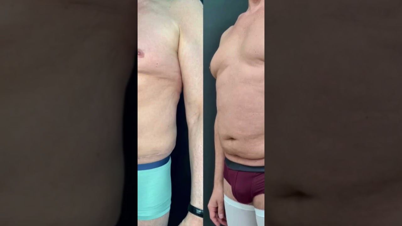 Мужская #абдоминопластика