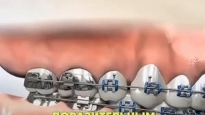 Как работают металлические брекеты