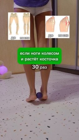Кто сказал, что деформацию ног нельзя исправить? Проект "СТОПЫ" по ссылке в описании
