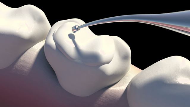 Удаление кариеса смотреть онлайн