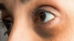 Как убрать темные круги под глазами