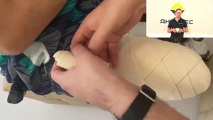 Как подготовить культю к протезированию