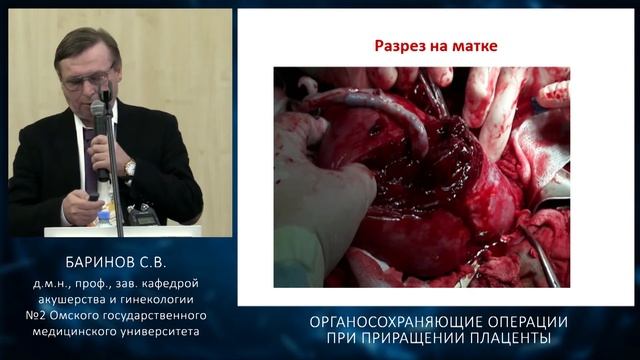 Баринов  С.В. Органосохраняющие операции при врастании плаценты