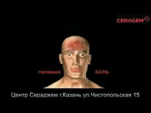 Шейный хондроз.