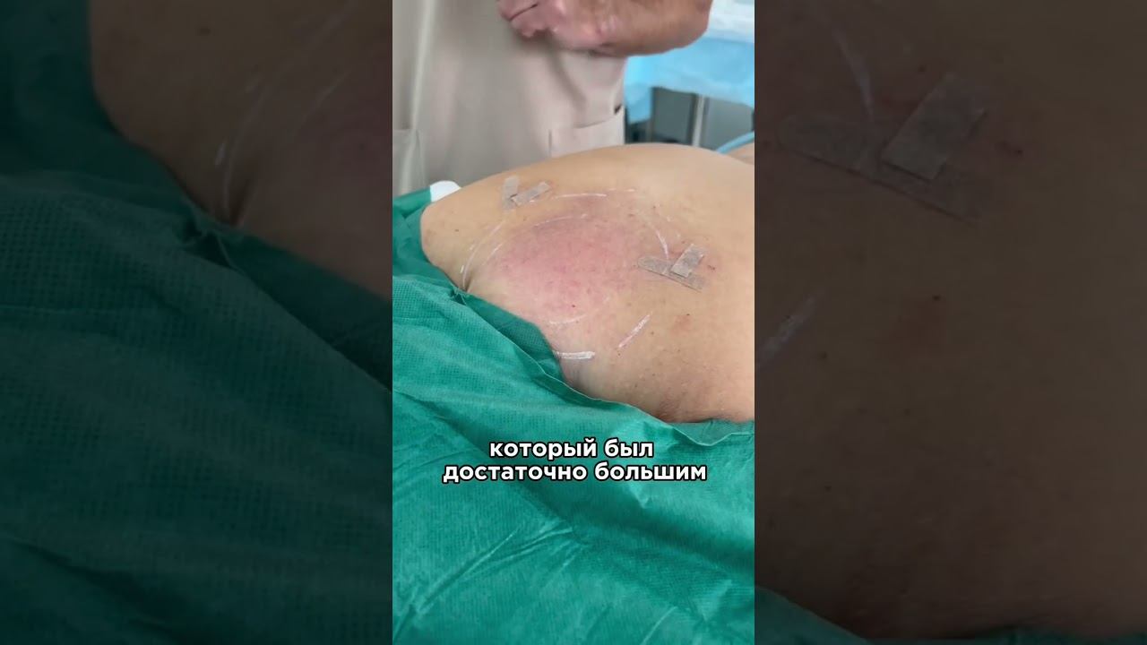 Как убрать горб на шее? #липосакция