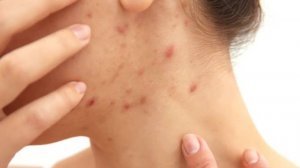 Как бороться с акне