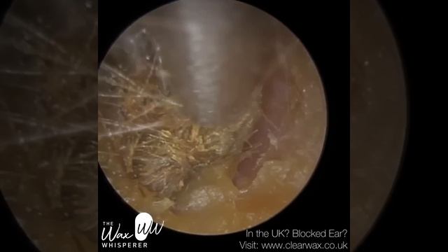 1,203 - Fully Impacted & Blocked Ear Wax Plugs Removal