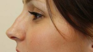 Коррекция носа без операции