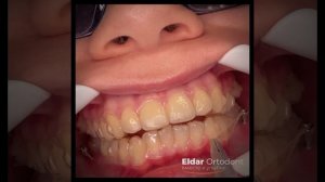 Винты и элайнеры #брекетымосква #ортодонтическоелечение  #винирымосква #ортодонтмосква