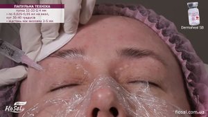 Корекція післяпологової гіперпігментації мезококтейлем 💉Dermaheal SB