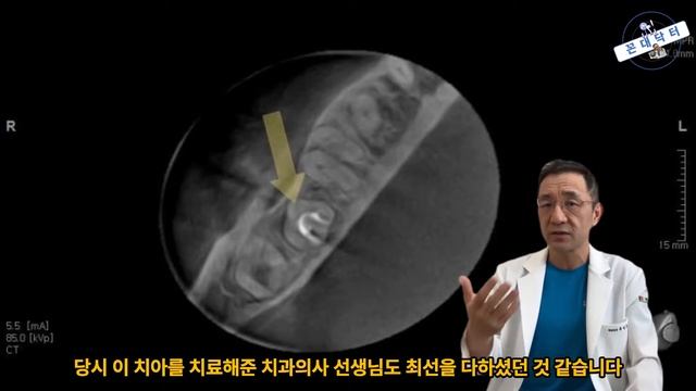 신경치료 실패한 자연치아도 발치는 신중해야 임플란트 대신 치아재식술로 살려서 쓰기
