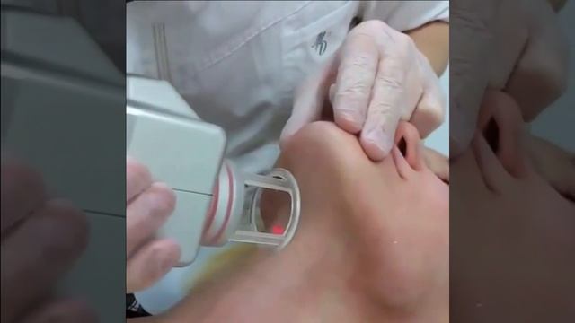 CO2 лазер Космопульс шлифовка подбородка
