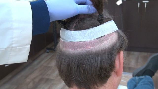 FUT Advanced Hair Loss Fix Demonstration Of Donor Scar With Strip Method by Dr Diep смотреть онлайн