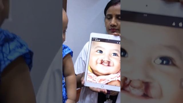 Cleft Lip Surgery Results After 3 months #shorts
