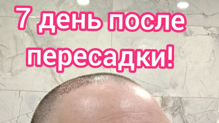 Пересадка волос. 7 день после пересадки волос. Неделя!!! #сергейричман